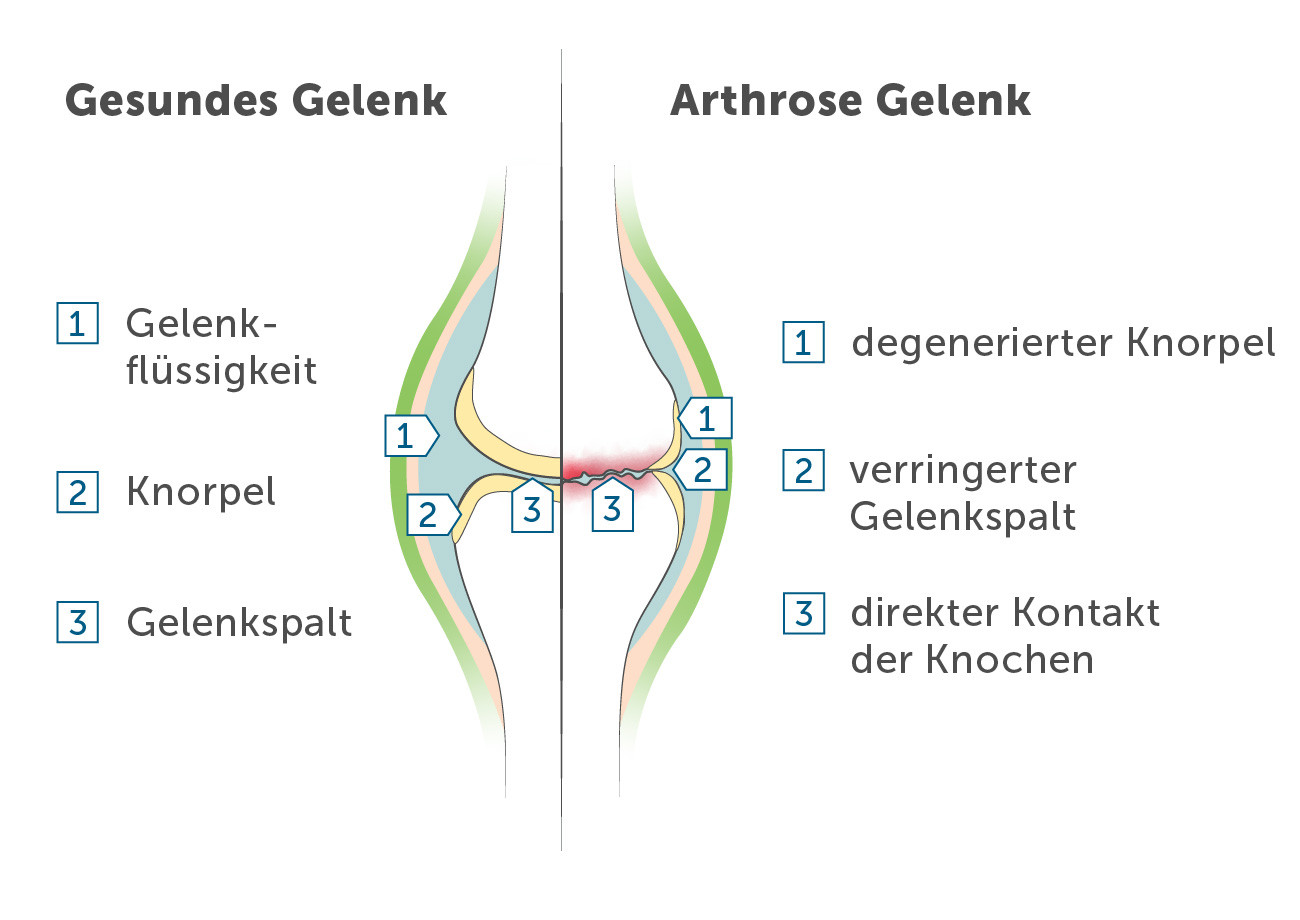 arthrose gelenkverschleiß
