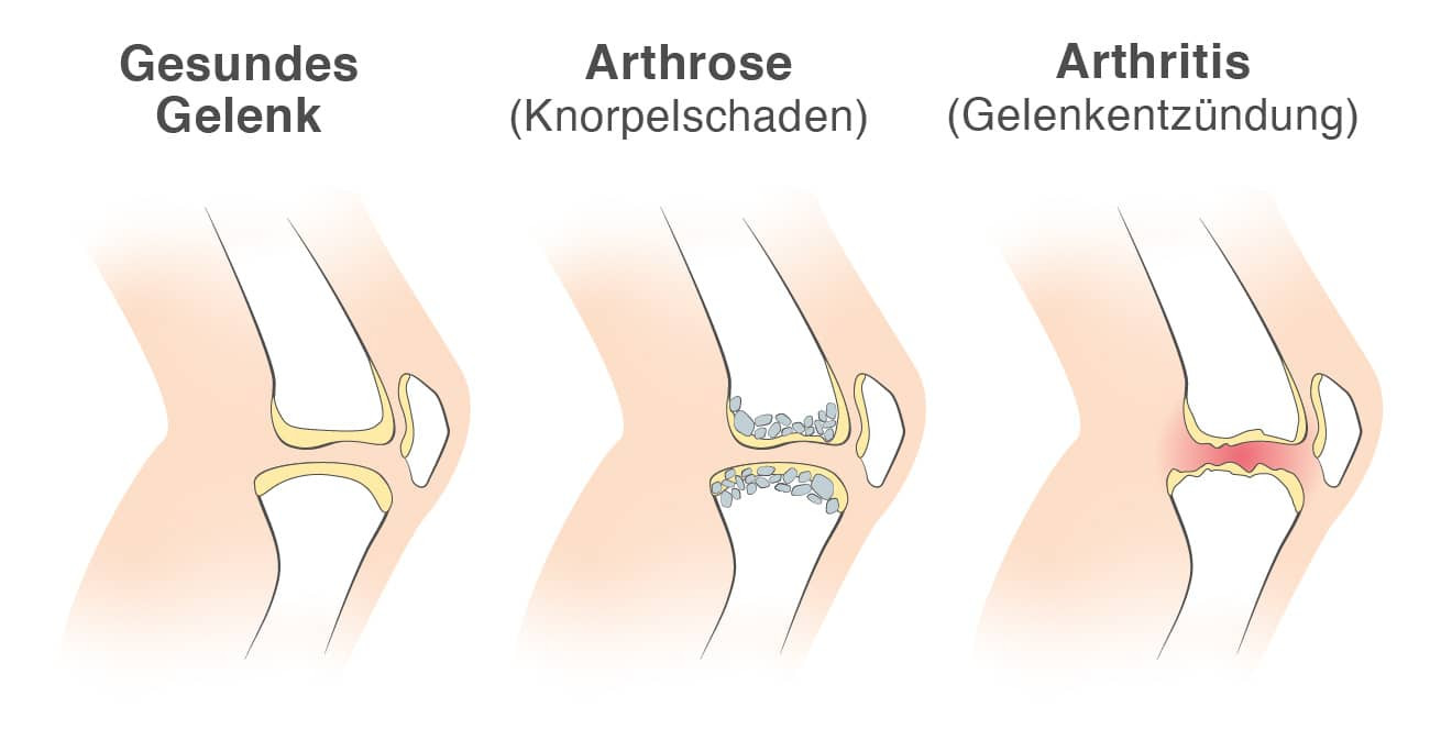 Vergleich gesundes Gelenk, Arthrose, Arthritis