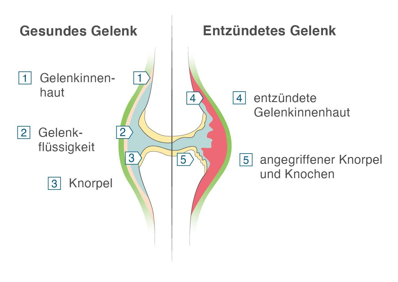 Gesundes Gelenk vs entzuendetes Gelenk (Arthritis)