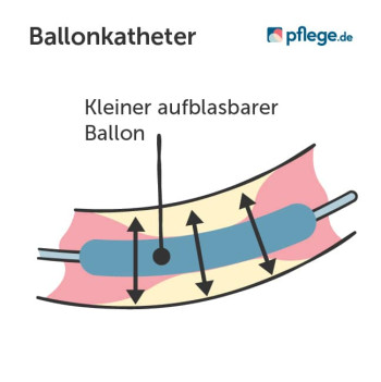 Ballonkatheter nach Herzinfarkt
