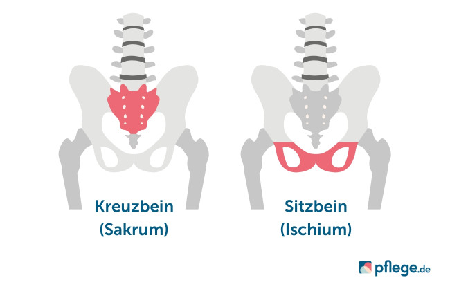 Dekubitus am Kreuzbein und am Sitzbein (Anatomie)