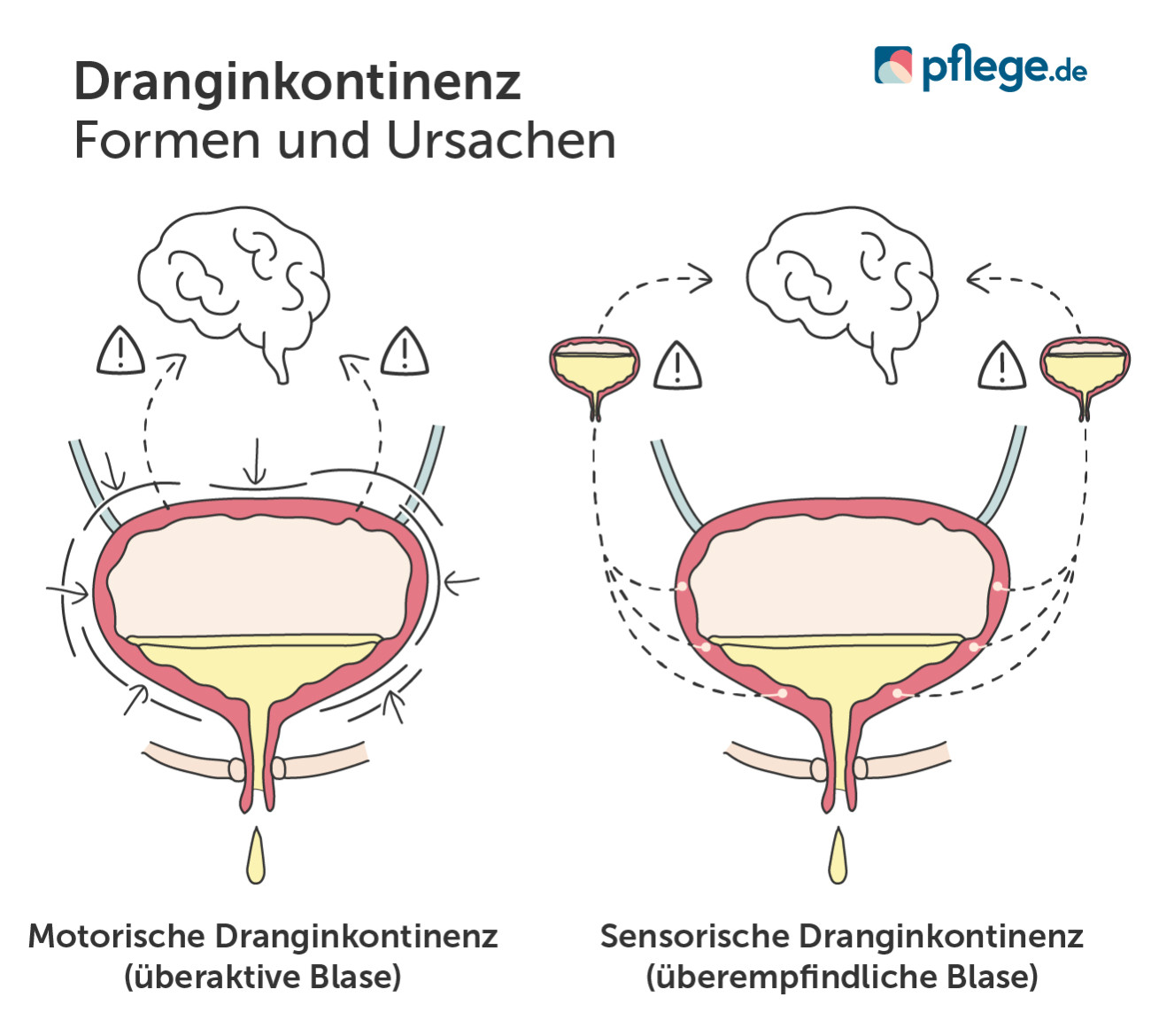Dranginkontinenz Formen Ursachen