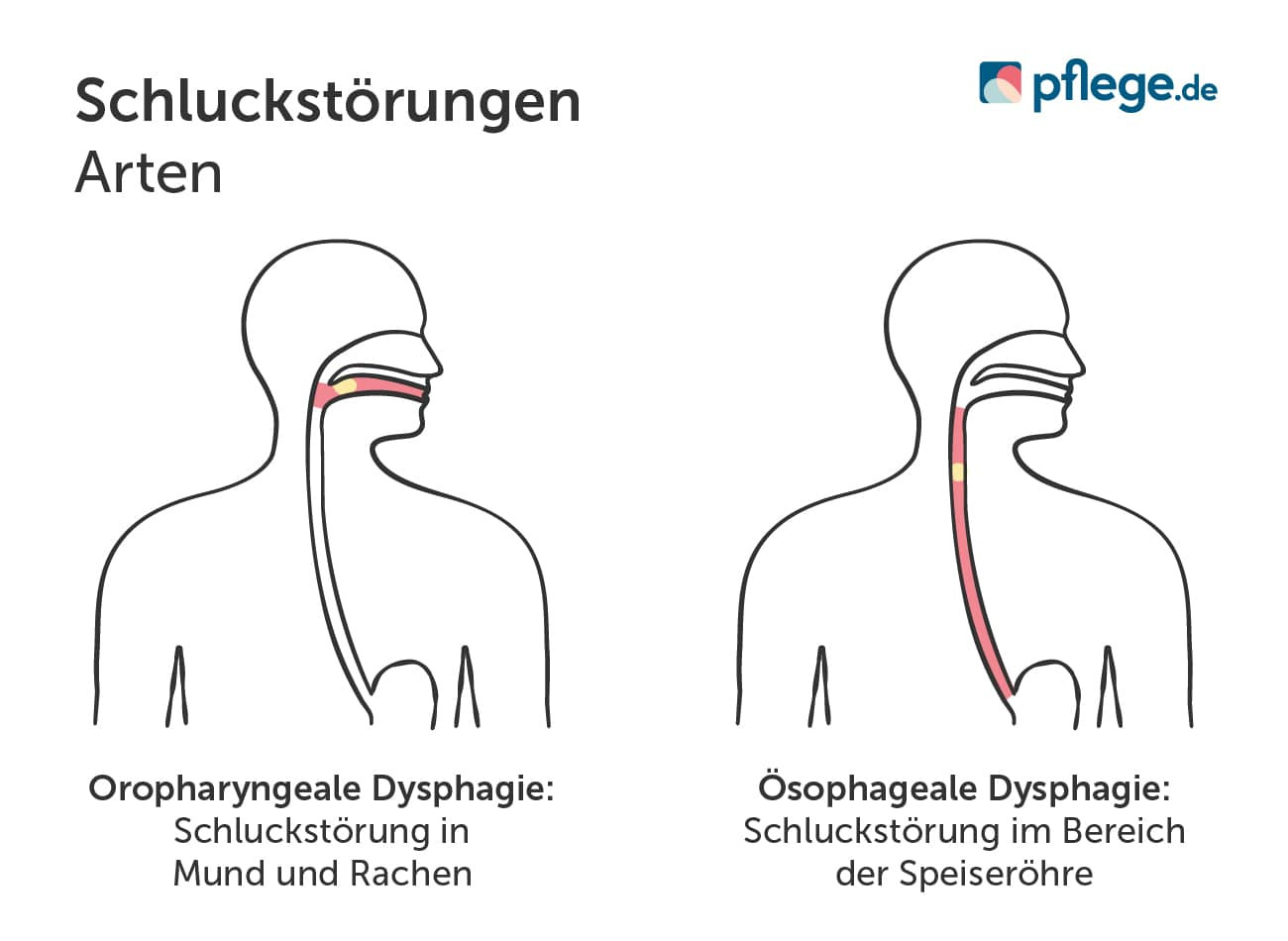 Dysphagie-Arten im Vergleich