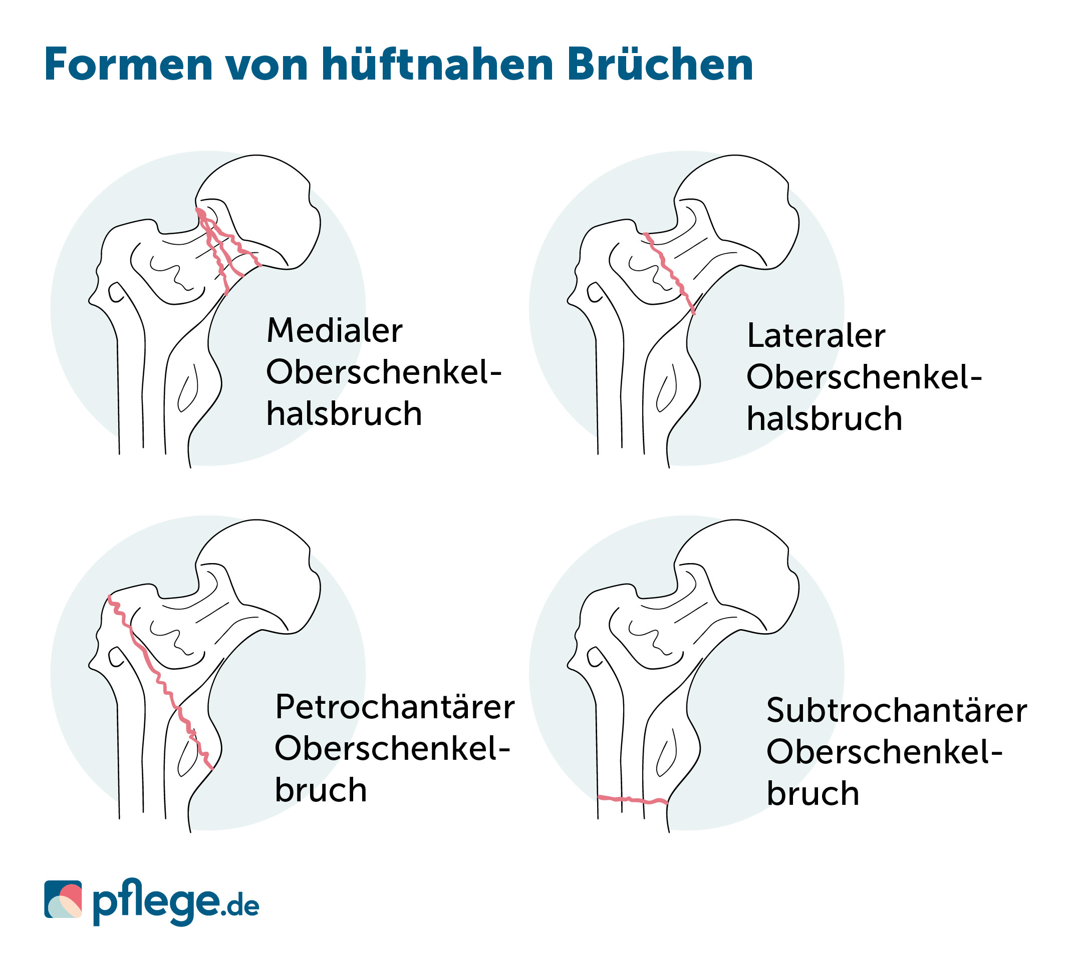 Formen von hüftnahen Brüchen