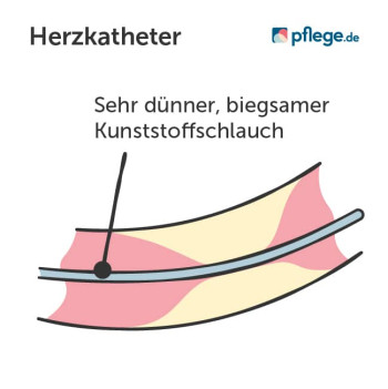 So sieht ein Herzkatheter aus