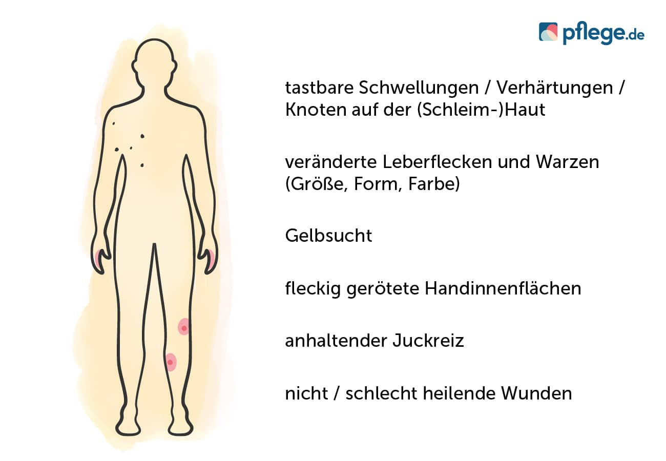 Mögliche Anzeichen für eine Krebserkrankung der Haut