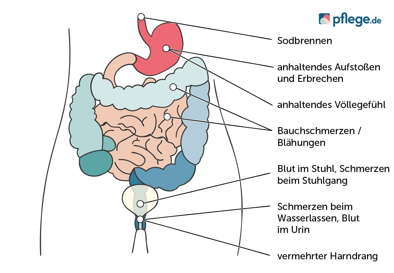 Mögliche Anzeichen für eine Krebserkrankung im Magen-Darm-Trakt und Harn-Trakt