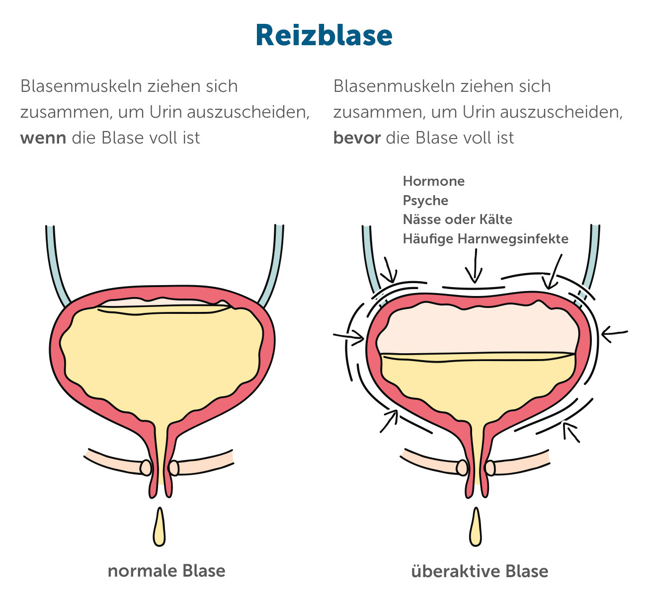 Reizblase und normale Blase im Vergleich