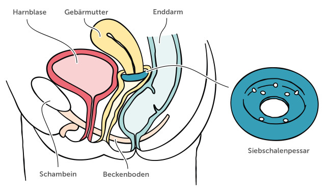 Siebschalenpessar