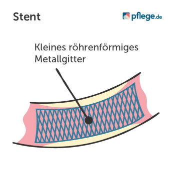Stent nach Herzinfarkt