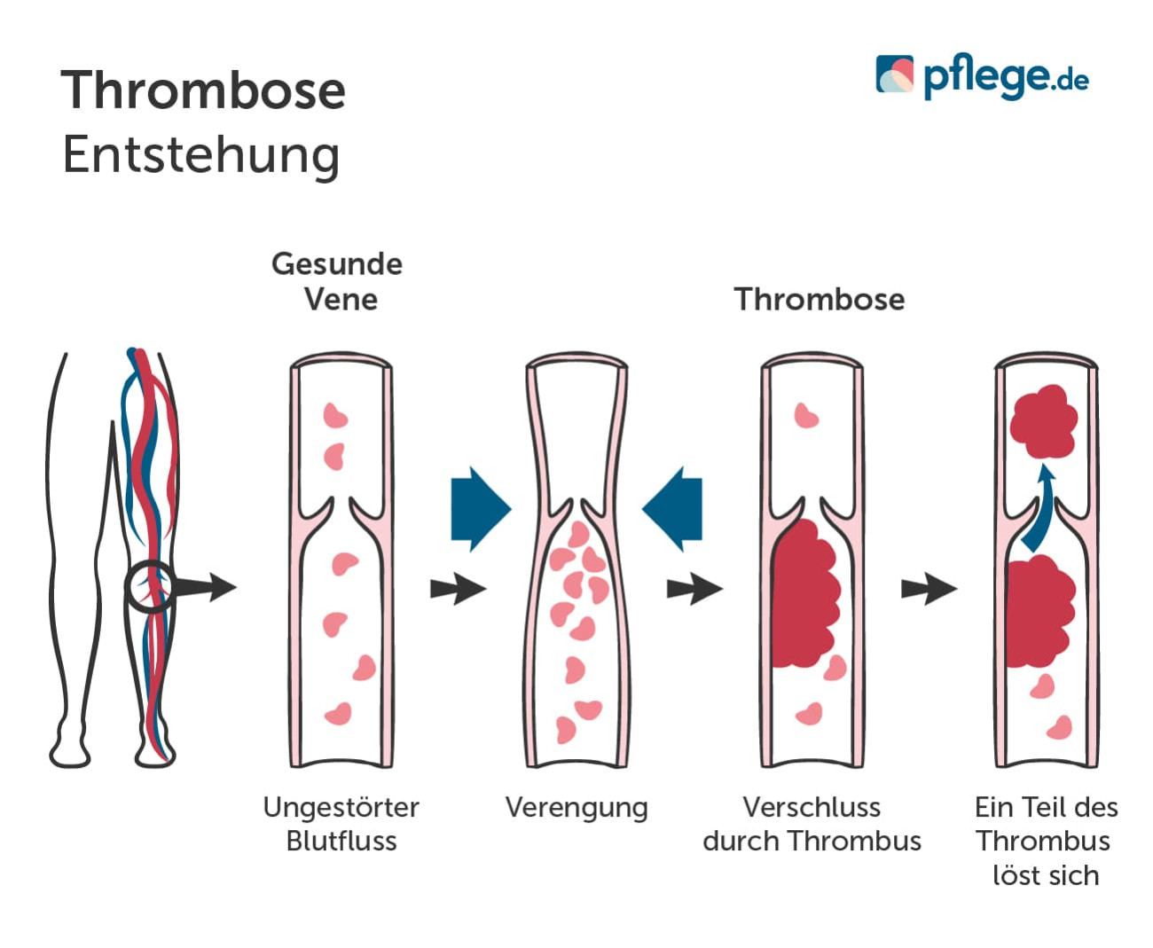 So entsteht eine Thrombose