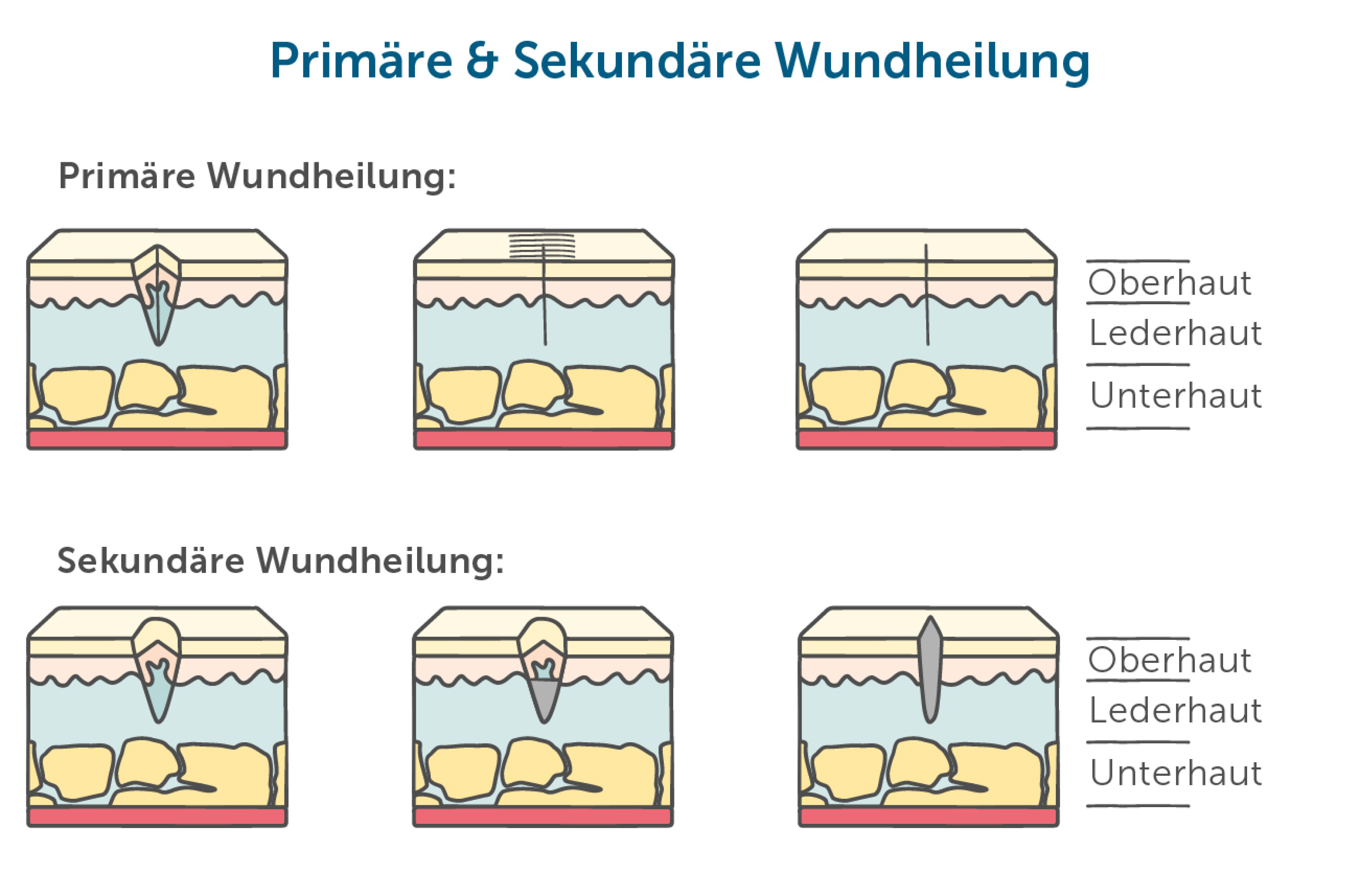 Wundmanagement » Wundversorgung in der Pflege | pflege.de